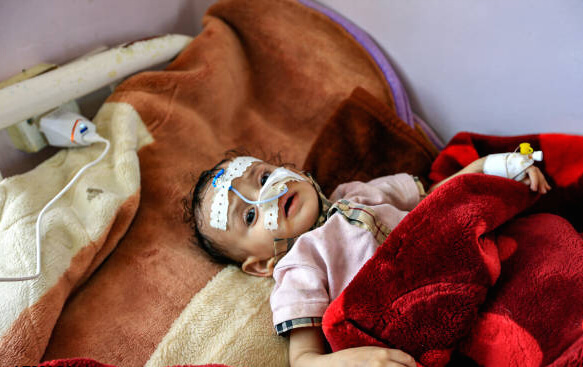 Photo of Yemen, allarme malnutrizione bambini a Sana’a