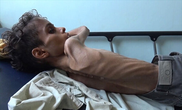 Photo of Yemen, Onu chiude il 70% dei servizi sanitari